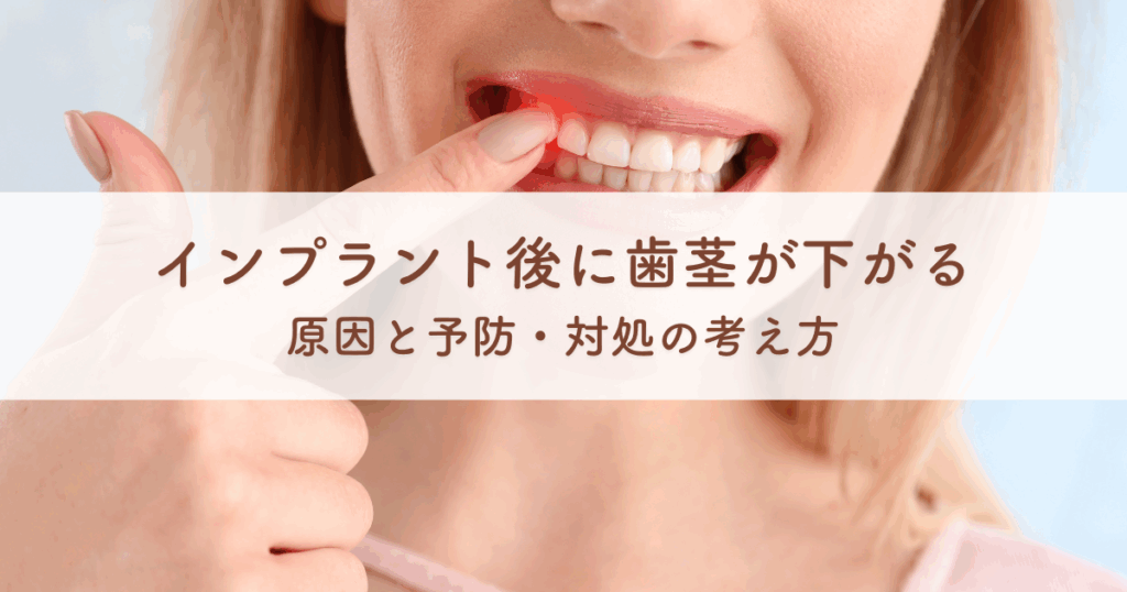 インプラント後に歯茎が下がる原因と予防・対処の考え方