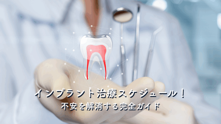 インプラント治療スケジュール！不安を解消する完全ガイド